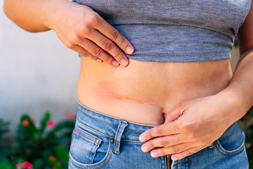 Say Goodbye to Scars with Scar Revision Surgery