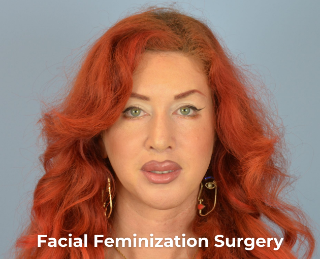 <p><strong>Facial Feminization Surgery</strong></p>
<ul>
<li><a href="/facial-feminization-surgery-gallery/">Facial Feminization Surgery</a></li>
</ul>